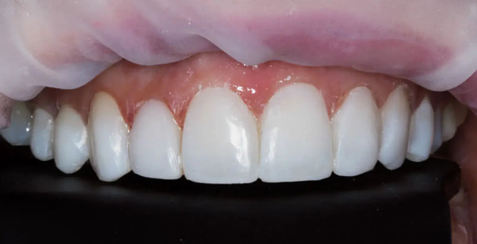Cosmetic Bonding Treatment: teeth after treatment