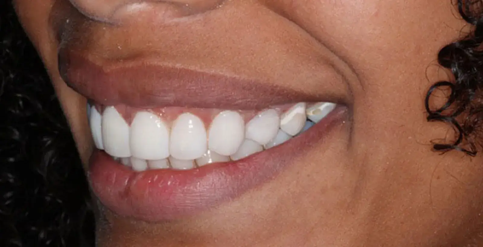 Cosmetic Bonding Treatment: teeth after treatment