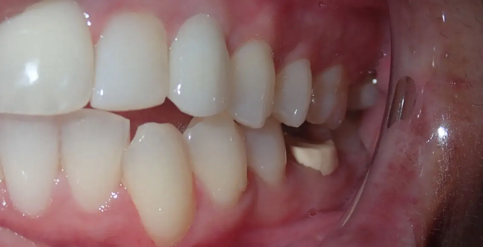 Close-up of a person's teeth showing an implant screw replacing a missing molar tooth on the lower jaw.