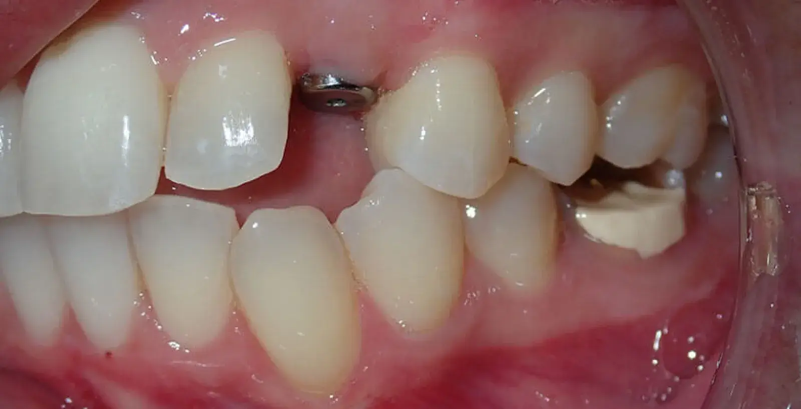 Close-up of a human mouth showing a dental implant surrounded by natural teeth.