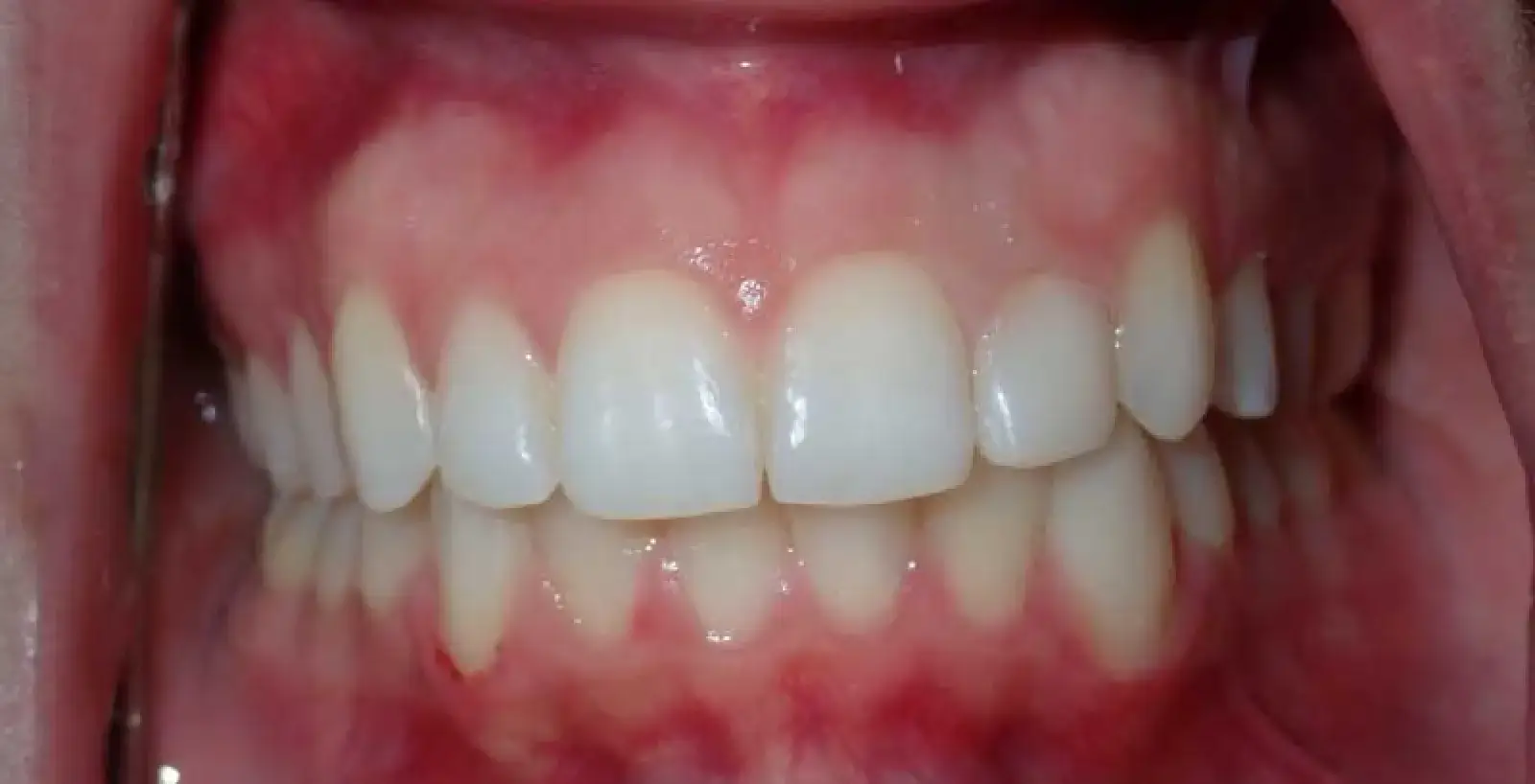 Diana: teeth after treatment