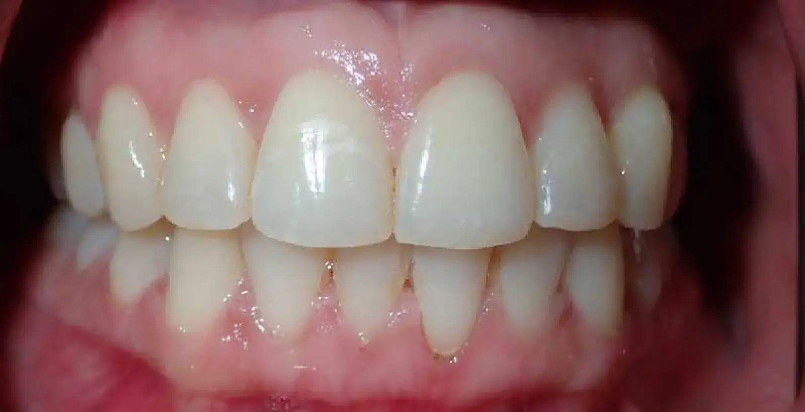 Gisel: teeth after treatment