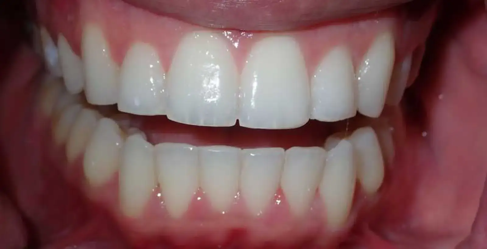Ivan: teeth after treatment