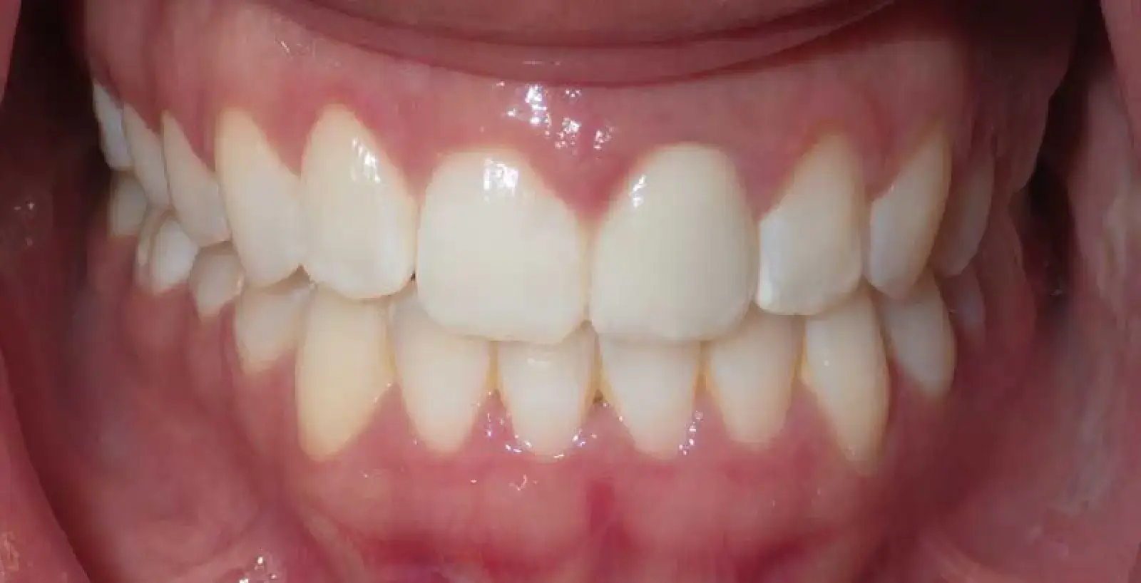 Melinda: teeth after treatment