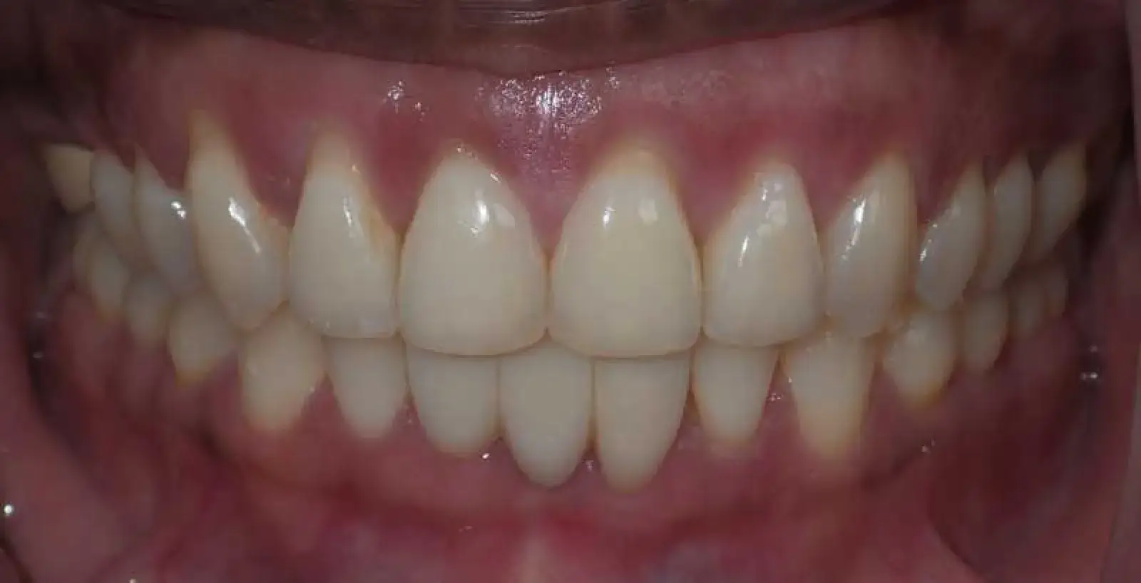 Nicola: teeth after treatment