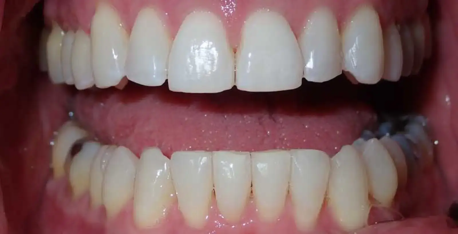 Patrick: teeth after treatment