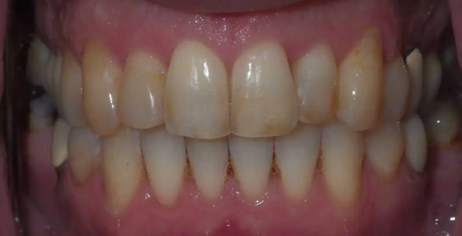Simon: teeth after treatment