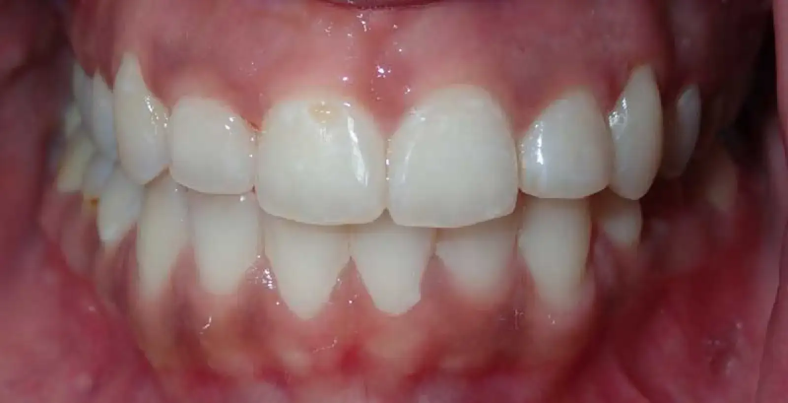 Tamara: teeth after treatment
