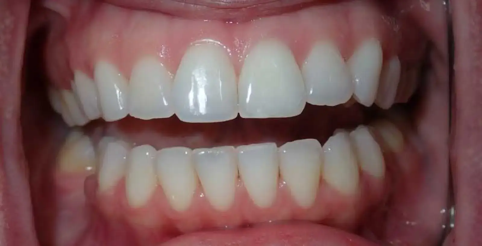 Ava: teeth after treatment