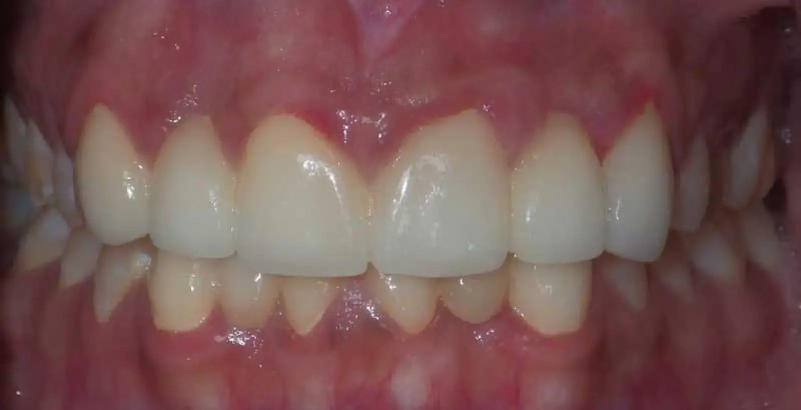 Bhola: teeth after treatment