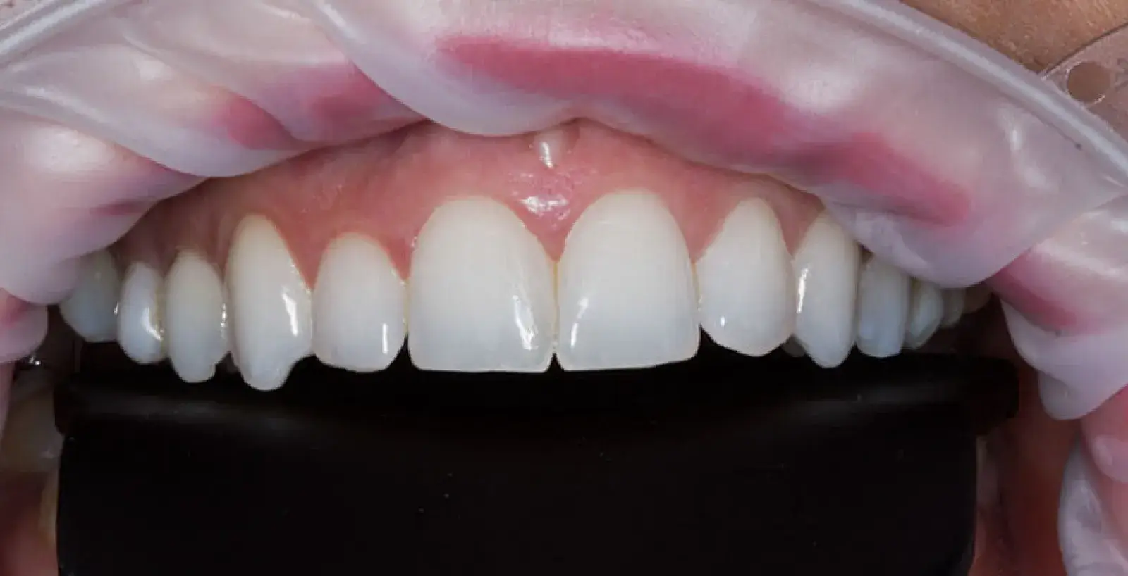 Cosmetic Bonding Treatment: teeth before treatment