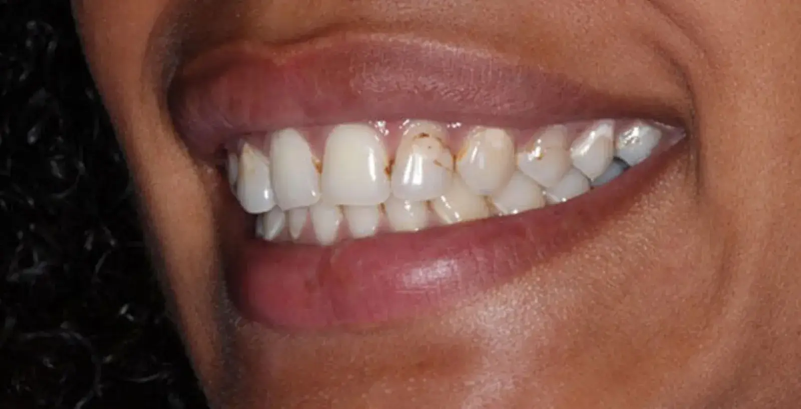 Cosmetic Bonding Treatment: teeth before treatment