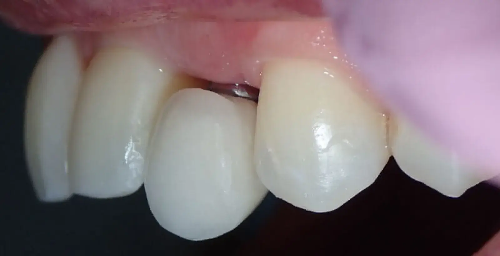 Close-up of a person’s teeth showing a dental implant next to natural teeth.