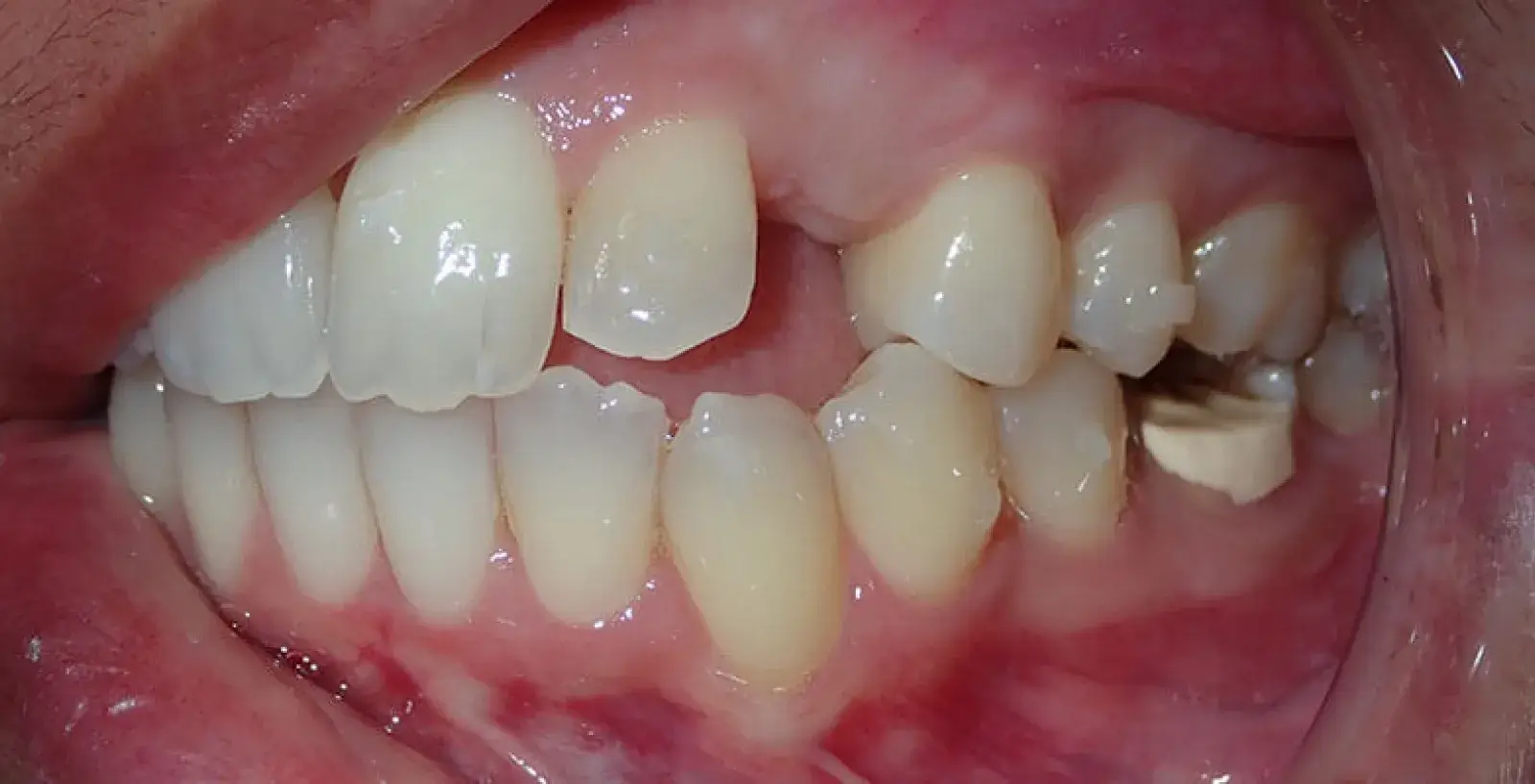 Simon: teeth before treatment