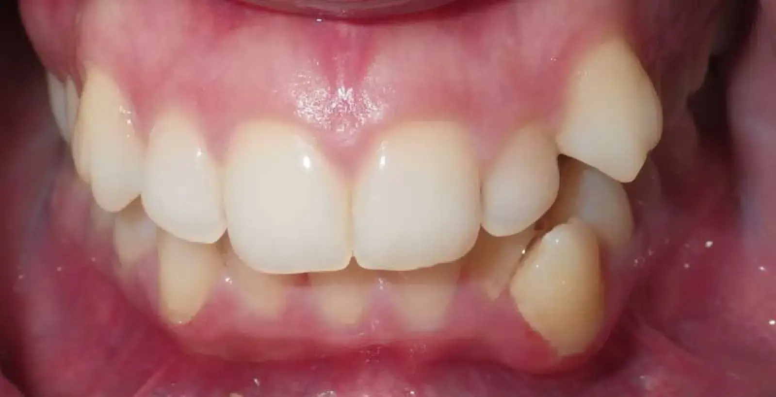 Diana: teeth before treatment