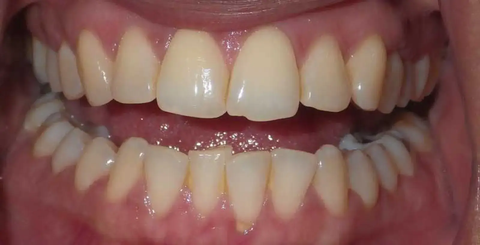 Gisel: teeth before treatment