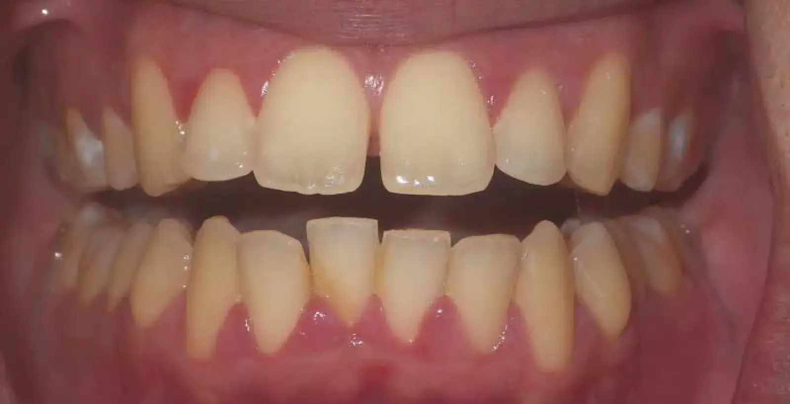Ivan: teeth before treatment