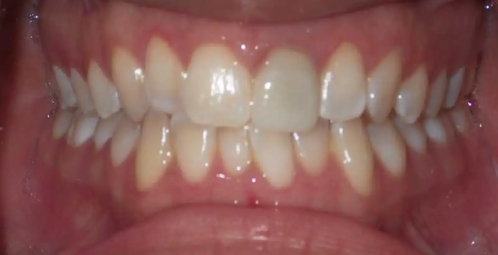 Melinda: teeth before treatment