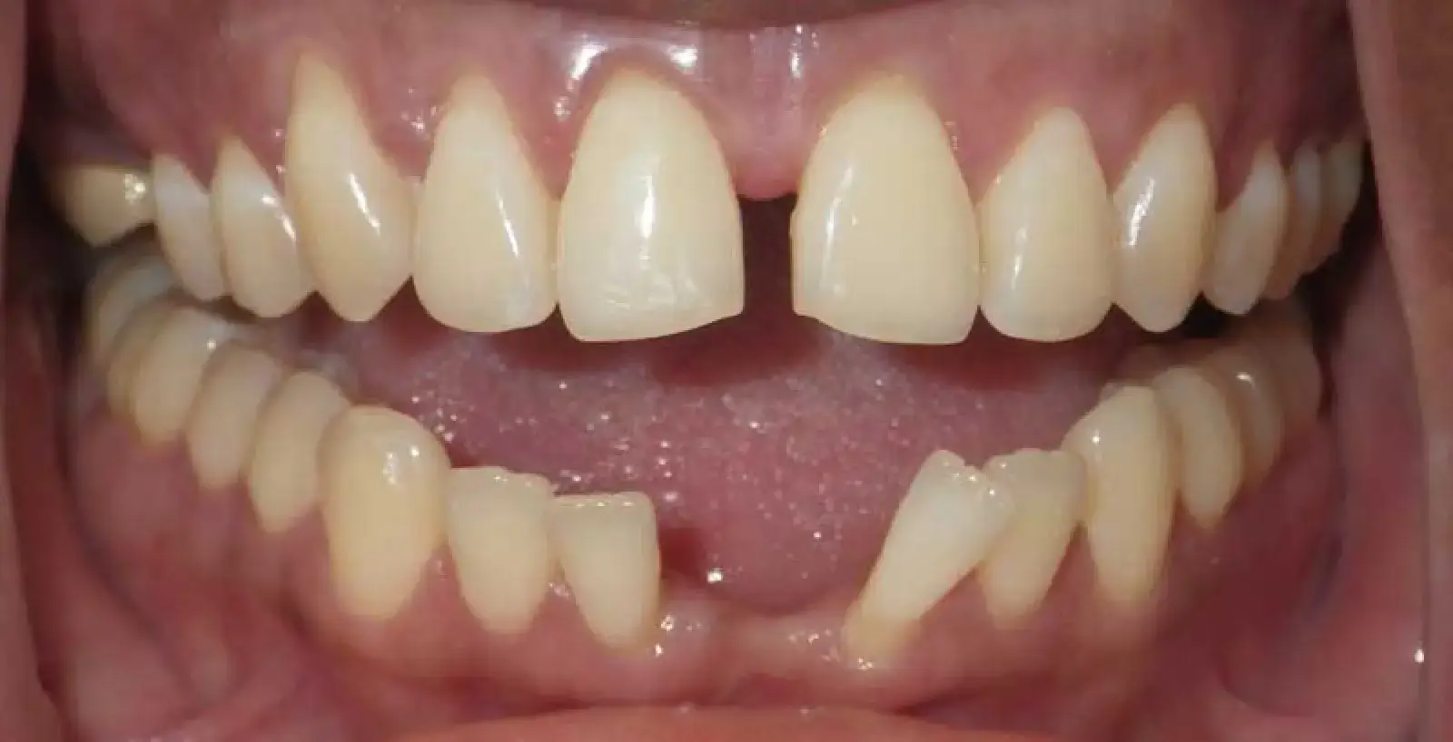 Nicola: teeth before treatment