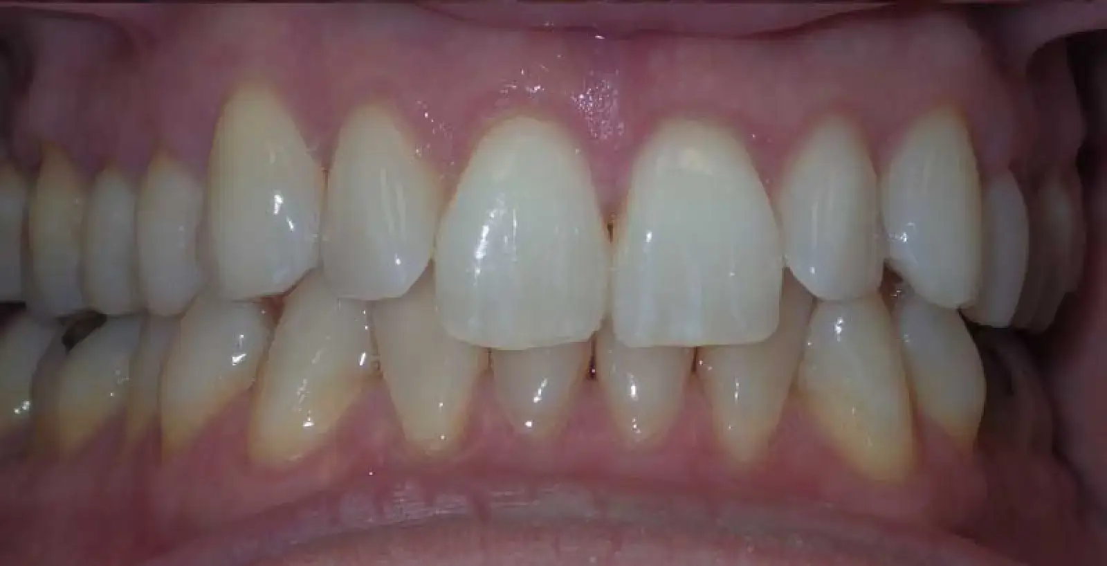 Patrick: teeth before treatment