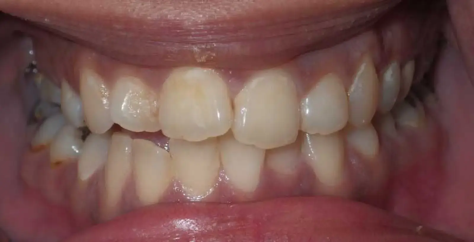 Tamara: teeth before treatment
