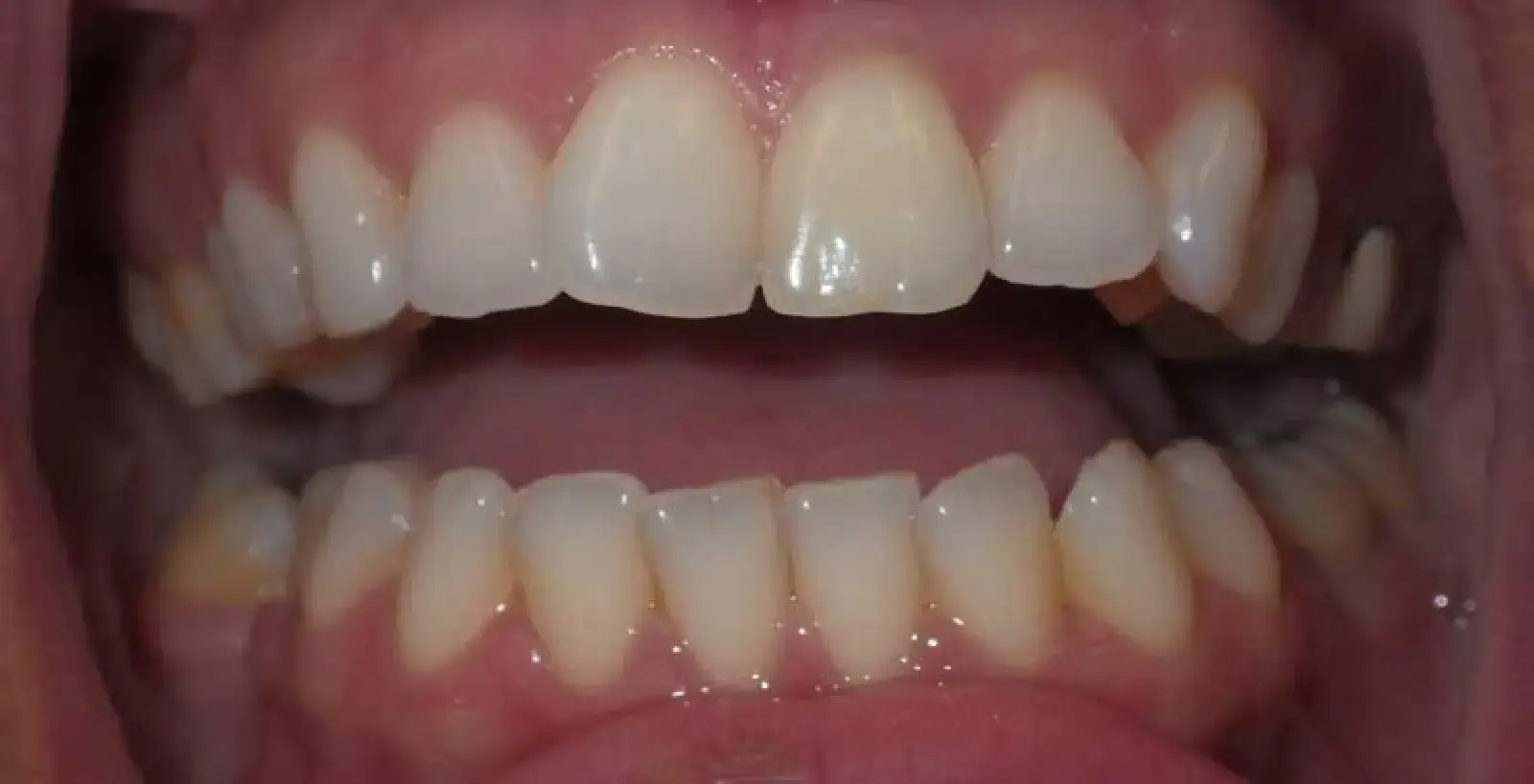Ava: teeth before treatment