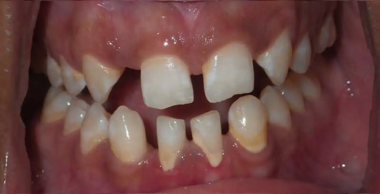 Bhola: teeth before treatment