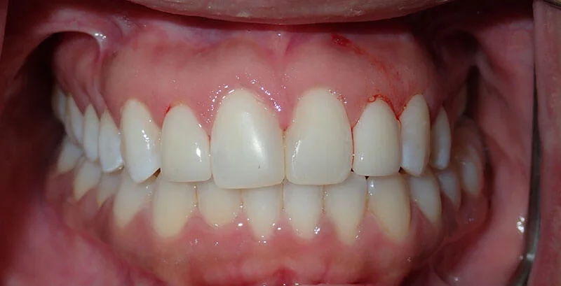 Karena: teeth after treatment