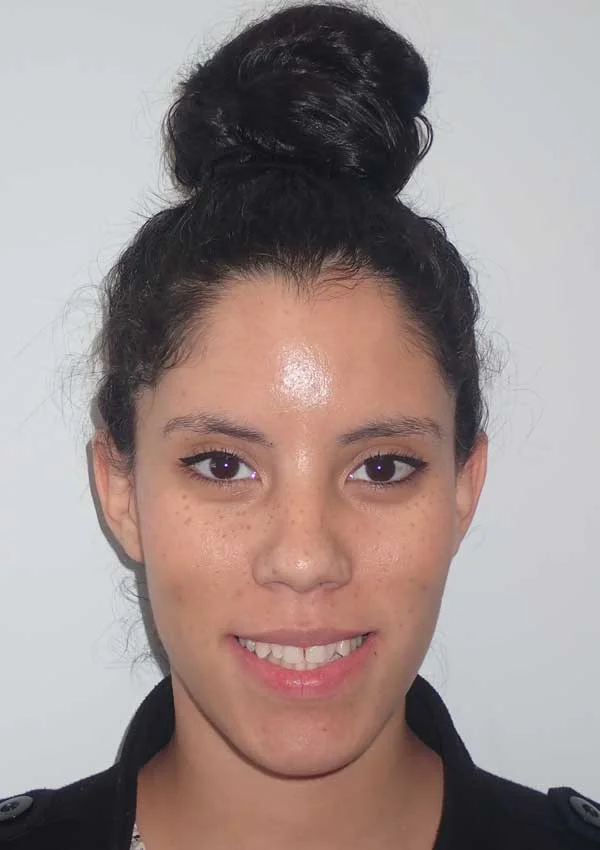 Karena: portrait before treatment