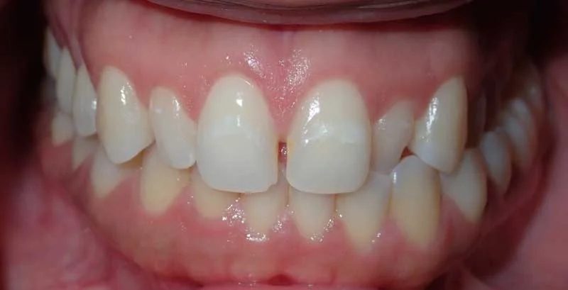 Karena: teeth before treatment