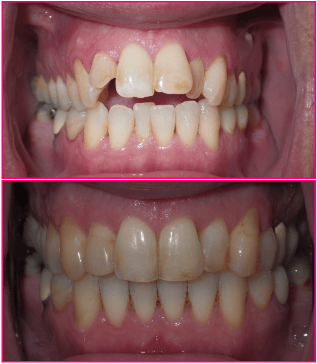 Dental treatment comparison 1: before above, after below.