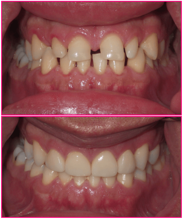Dental treatment comparison 2: before above, after below.