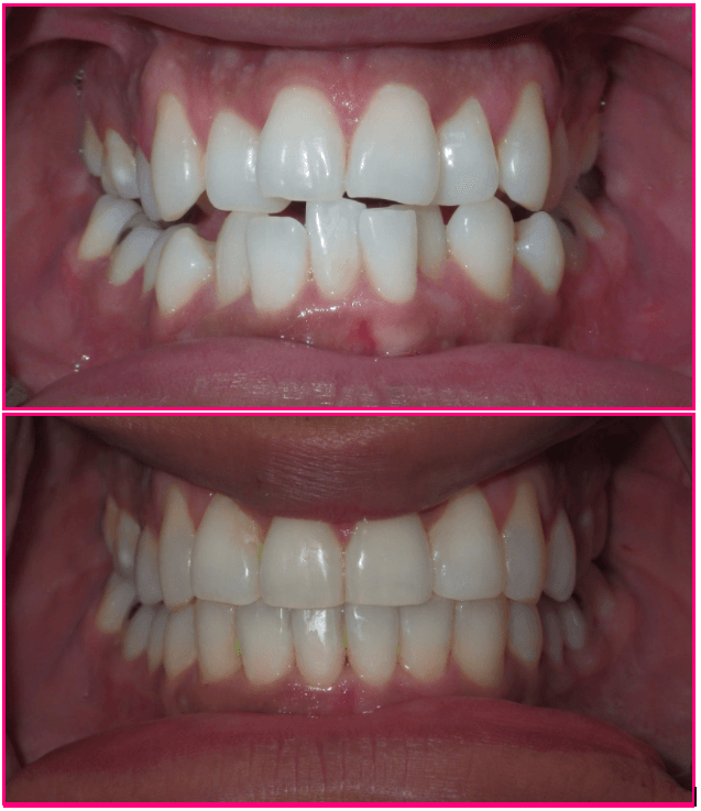 Dental treatment comparison 3: before above, after below.